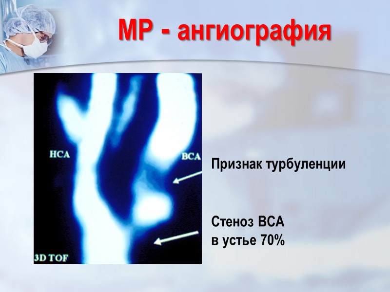 Стеноз ВСА  в устье 70% МР - ангиография Признак турбуленции